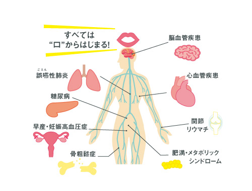 すべては口から始まる・誤嚥性肺炎、糖尿病、早産、妊娠高血圧症、骨粗鬆症、脳血管疾患、心血管疾患、関節リウマチ、骨粗鬆症、肥満、メタボリックシンドローム